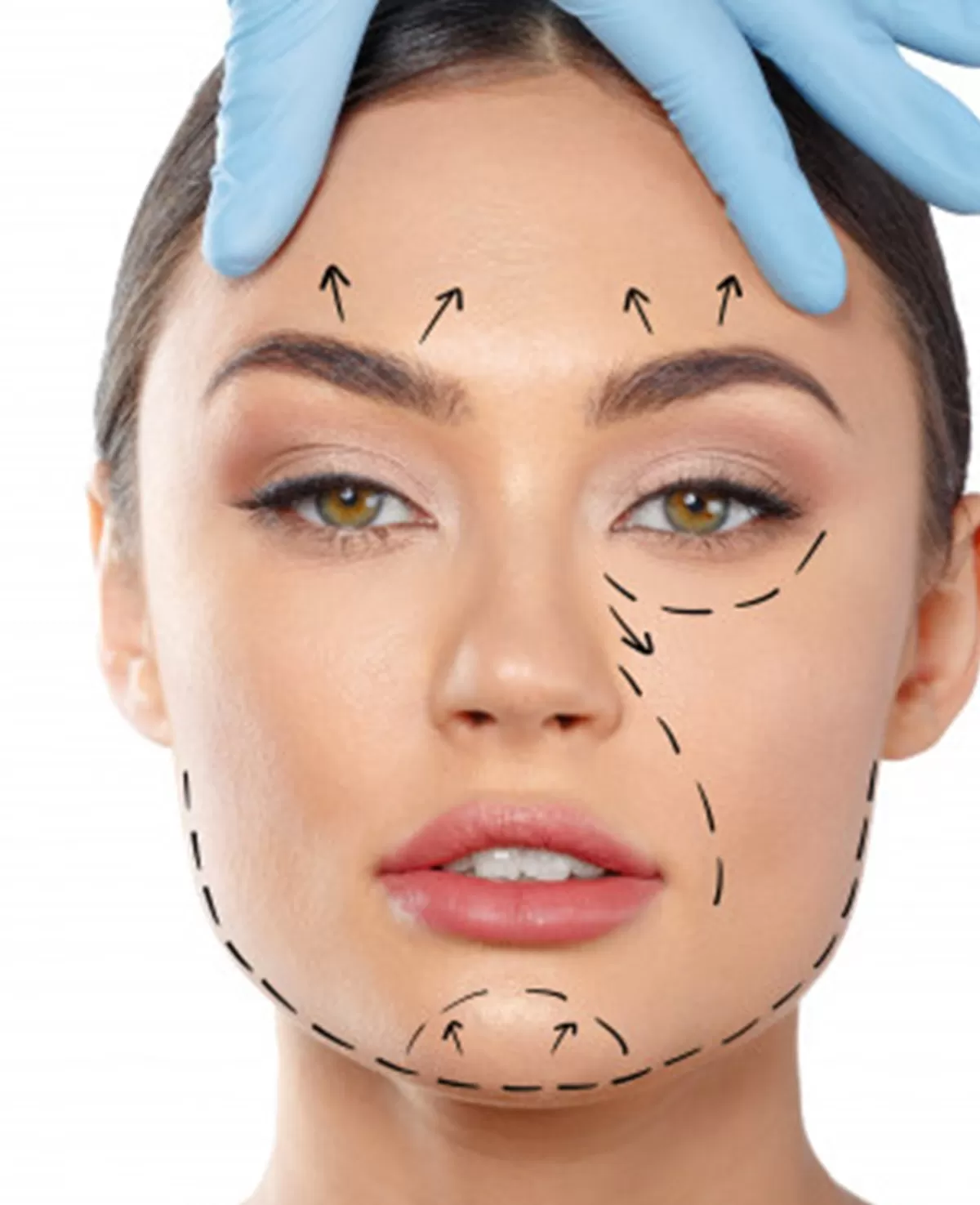 Esenyurt HI-FU (Ameliyatsız Cilt Gençleştirme)