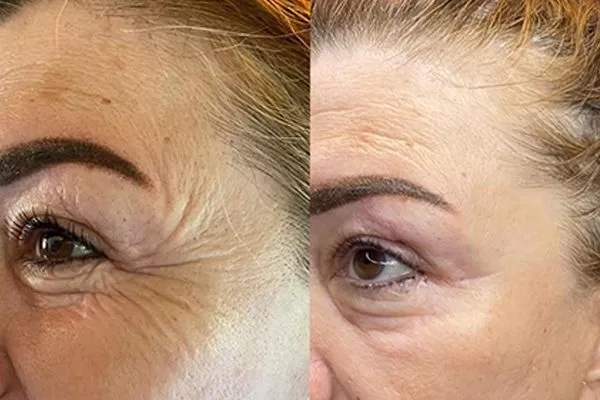  Kâğıthane Kolajen İp Uygulaması