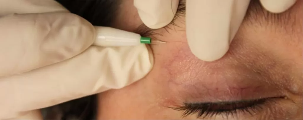  Beyoğlu İğneli Epilasyon